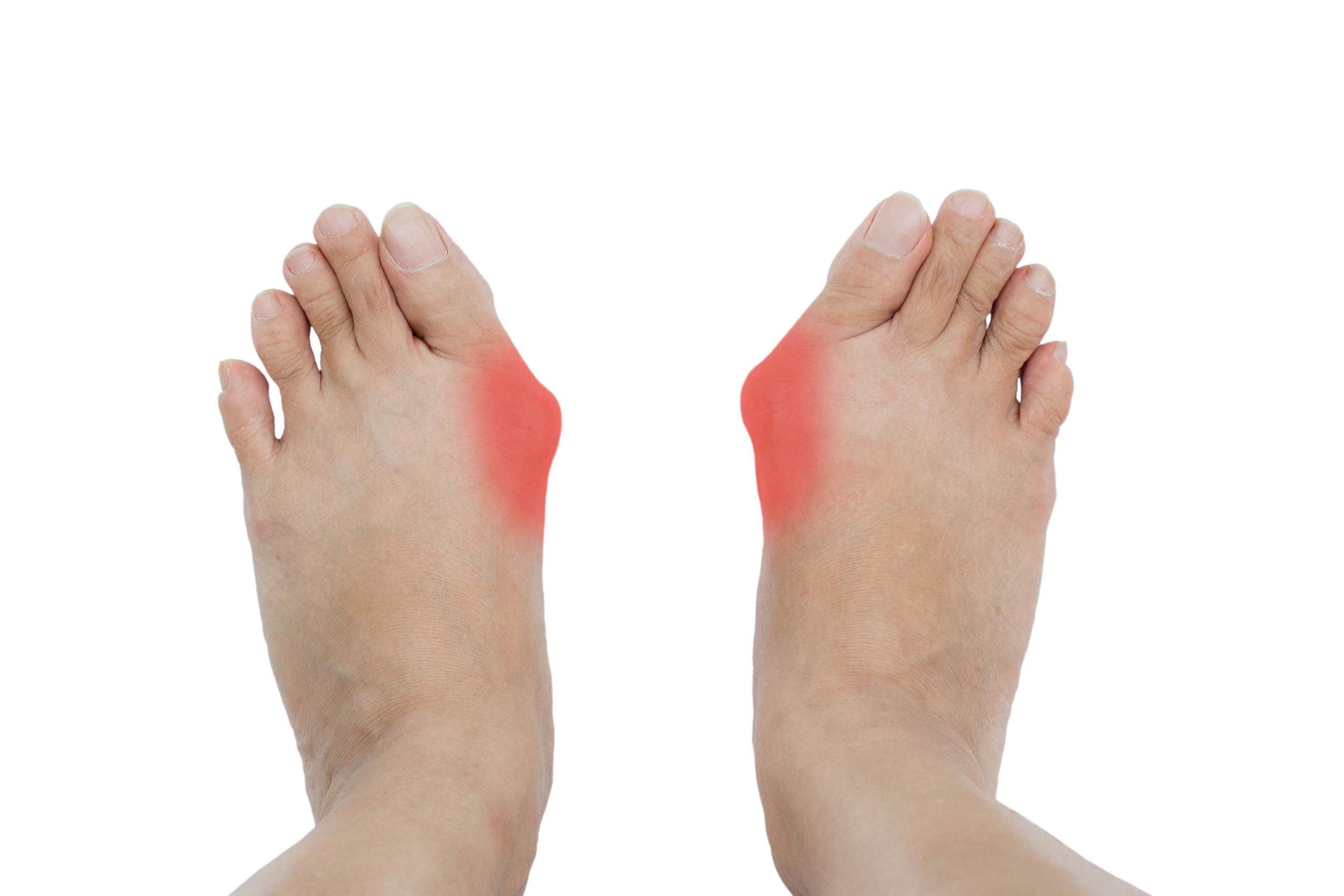 voetklacht Scheve grote teen (hallux valgus)